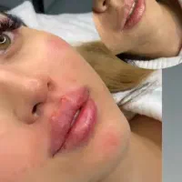 جشنواره ژل لب روسی و بوتاکس