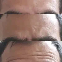 تخفیفات ژل بوتاکس مزو میکرو