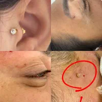 تخفیف ویژه برداشت خال،زگیل،منگوله،انجام پرسینگ