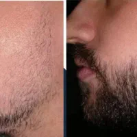 کاشت ریش بدرد نمیخوره
