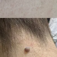 خال برداری بدون خونریزی و جراحی