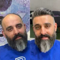 پروتز مو