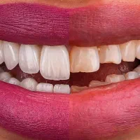 زاویه سازی صورت یا لبخند زیباتر