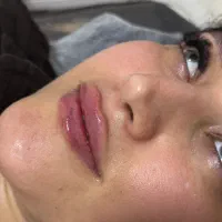 تخفیف ویژه بوتاکس،ژل لب‌،لیفت صورت بانخ توسط پزشک