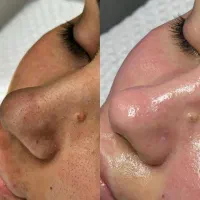 پاکسازی و فیشال پوست