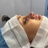 آف جراحی بینی ۲۰ت دراهوازلیپوساکشن ولیفت