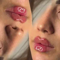 تزریق ژل لب بوتاکس پیرسینگ مادلینگ صورت مزوتراپی
