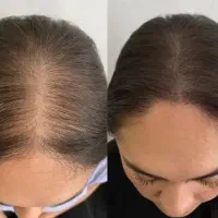 پی آر پی ممنوع