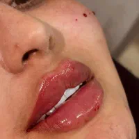 همه خدمات تزریق ژل لب فیلر بوتاکس لیزر آفر ۶۰ درصد