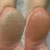 پدیکور پا.کف سابی پارافین تراپی