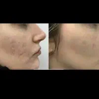 برداشت خال و زگیل تضمینی آف 70٪ .بوتاکس ژل