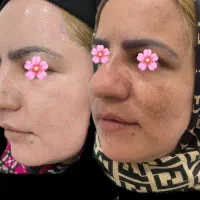 رفع دائمی لک پوست با لیزر co2 ترکیبی