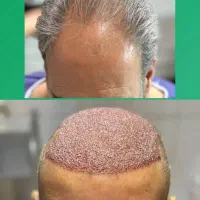 کاشت مو و ابرو طبیعی نقد و اقساط