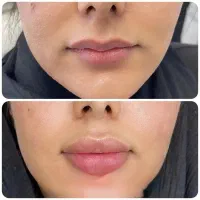 تزریق ژل وبوتاکس تخفیفات امروز رو از دست ندید