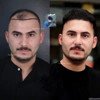 کاشت مو با ۱۲ میلیون تخفیف
