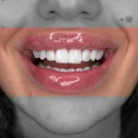 جشنواره کامپوزیت لمینیت عصب کشی روکش ترمیم EMAX
