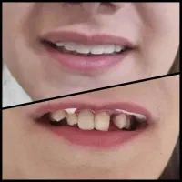 کامپوزیت دندان از دم قسط