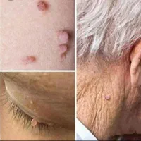 کلینیک لیزر کرایو زگیل خال میخچه حجامت زالو بوتاکس