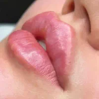 تزریق ژل و بوتاکس و فیلر لب