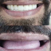 دندان مصنوعی، پروتز، BPS، لردگان