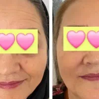 بیوممتیک رفع چین و چروک فوری