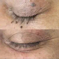 برداشتن خال و ضایعات پوستی