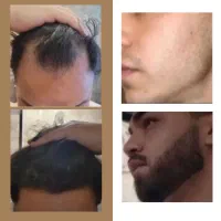 نه کچل باش نه کوسه