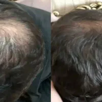 رفع اصولی کم پشتی و ریزش مو