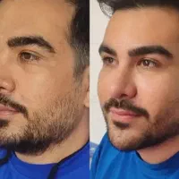 افر ویژه ژل بوتاکس پی ار پی مزو در مطب زیبایی