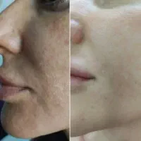 جدیدترین روش درمانی لک