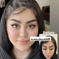 جوانترین نسخه شما.متدهای روزدنیا(ژل بوتاکس نخ مزو)