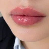 30%تخفیف ژل لب، بوتاکس، خط خنده ،گونه زاویه سازی