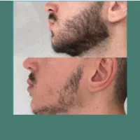 طی‌ 28 روز. همه جای صورتتو پرپشت. کن