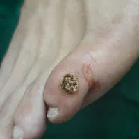 جشنواره پوست لیزرخال/زگیل/میخچه کلینیک شیخ مفید
