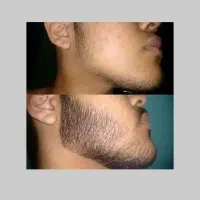 کاشت ریش ممنوع