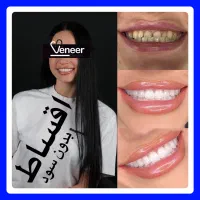 لمینت کامپوزیت(واحدی ۷۹۰ هزار) ایمپلنت دندانپزشکی