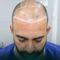 کاشت مو فقط در یک روز با ضمانت تراکم