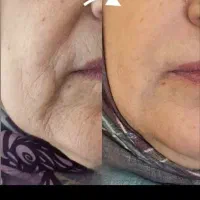 جوان سازی پوست صورت