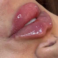 تزریق چربی صورت . ژل فول فیس . ژل لب تضمینی
