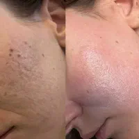 فیشیال پاکسازی پوست VIPو تخصصی