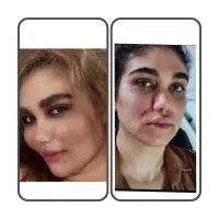 جشنواره تزریق ژل فول فیس و بوتاکس