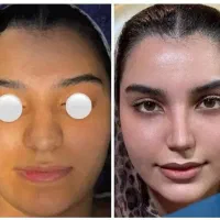 عمل جراحی بینی لیزری بدون کبودی/فوق تخصص/لیپو/لیفت
