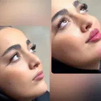 بوتاکس و فیلر پی ار پی لیفت نخ مزوتراپی کانتورینگ