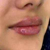 لیزر فیلر ژل بوتاکس هایفو الکترولیز لاغری