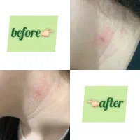 خالبرداری و برداشت زگیل و کک و مک در مطب