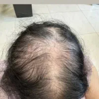 با ریزش مو وکچلی خداحافظی کن
