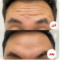 بوتاکس صورت تخصصی (تخفیف ویژه برای مدت محدود)