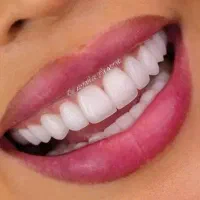 لمینت سرامیکی دندان بدون تراش دندانها طبیعی و زیبا
