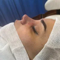 آف عمل جراحی بینی وساکشن فقط۲۵ت دراهواز