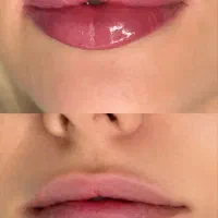 بوتاکس ژل فیلر پی ارپی فول فیس پزشک انزیم اموزش